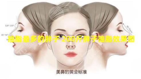 抽脂最多的胖子 200斤胖子抽脂效果图